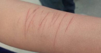 विद्यार्थीलाई हात चिर्न लगाउने शिक्षिका प्रहरी नियन्त्रणमा